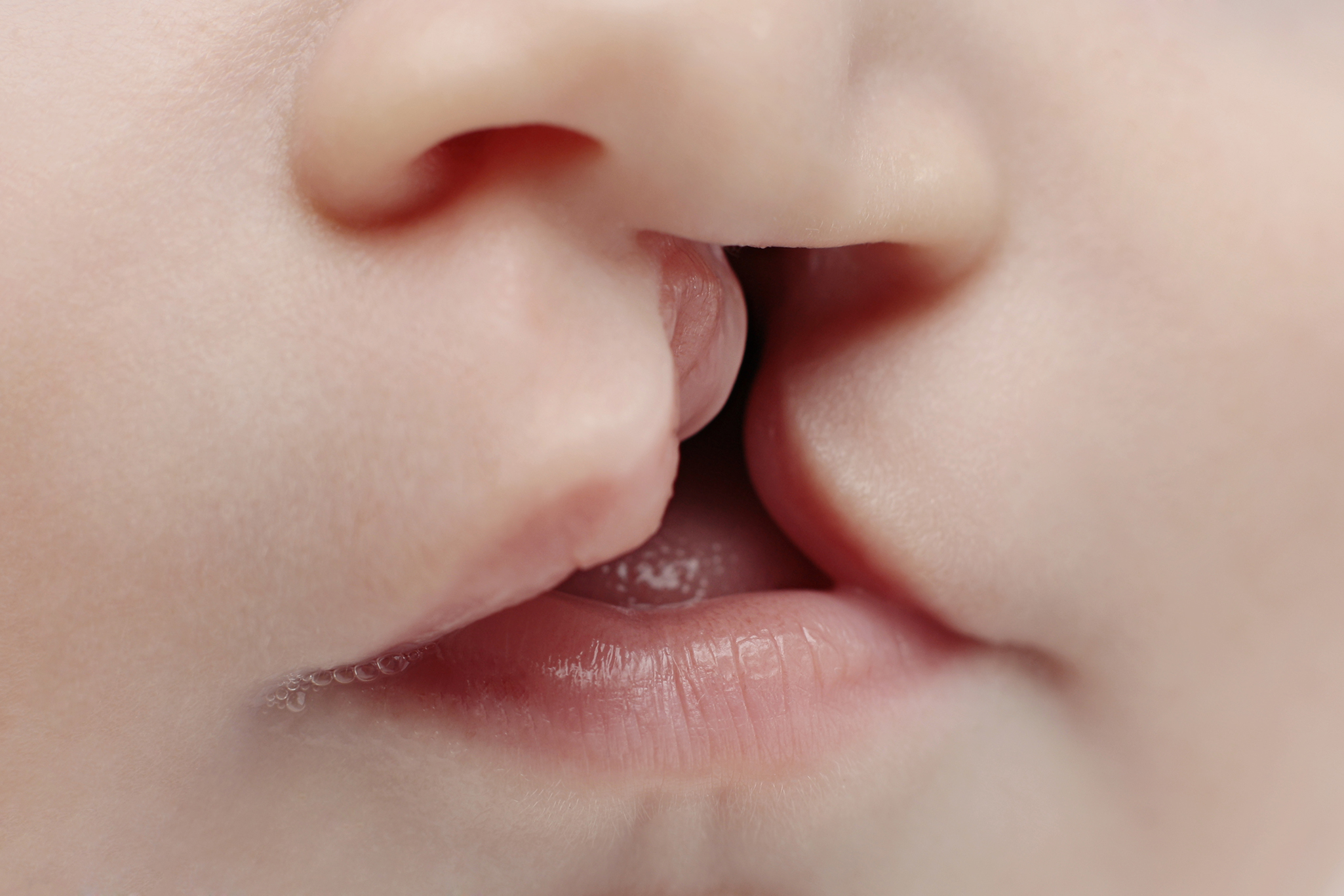 Parent’s Guide: What You Need To Know About Cleft Lip and Palate?